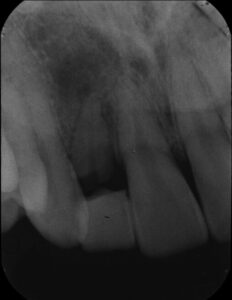根が折れてしまった前歯をインプラントで治療した症例【前歯部審美症例10】